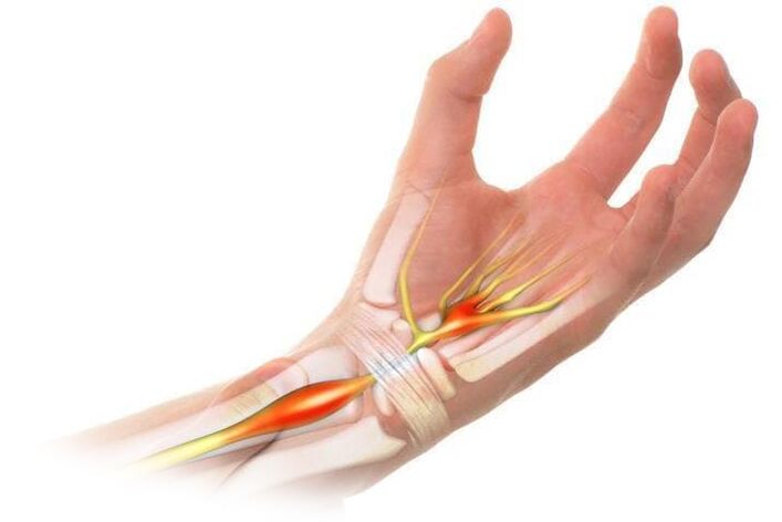 Pain with inflammation of the joints. 