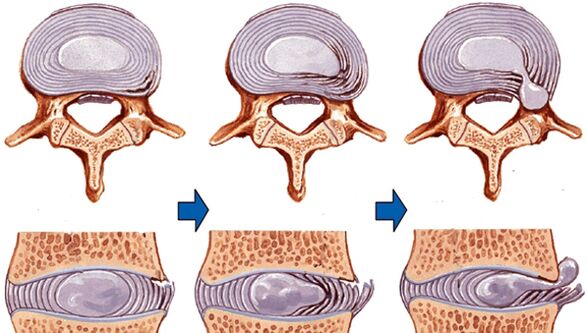 spinal cord injury in osteochondrosis