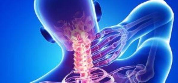 Cervical osteochondrosis