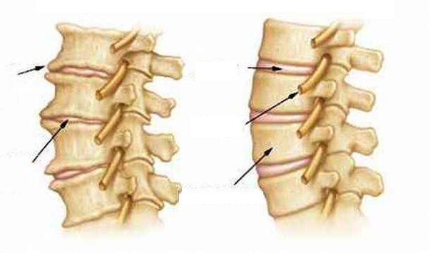 What is osteochondrosis
