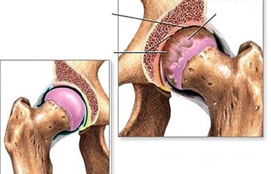 Hip osteoarthritis diagnosis