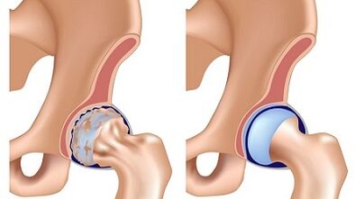 Symptoms of the arthrohrosis of the hip joint