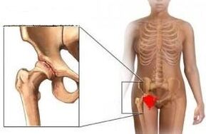 The reasons for the development of the osteoarthritis of the hip joint