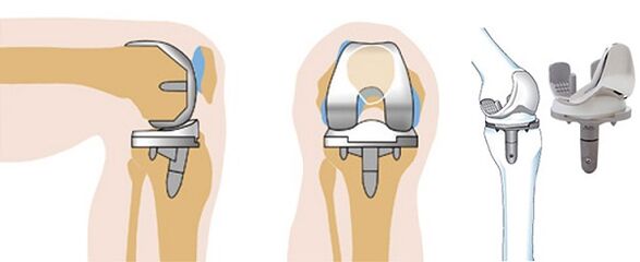 Endoprotic operation of the knee joint for osteoarthritis