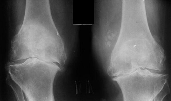 X -Ray as a way to diagnose the osteoarthritis of the knee joint