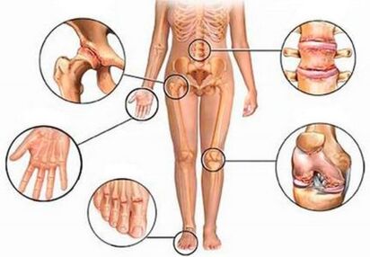 Arthritis and osteoarthritis of several joints