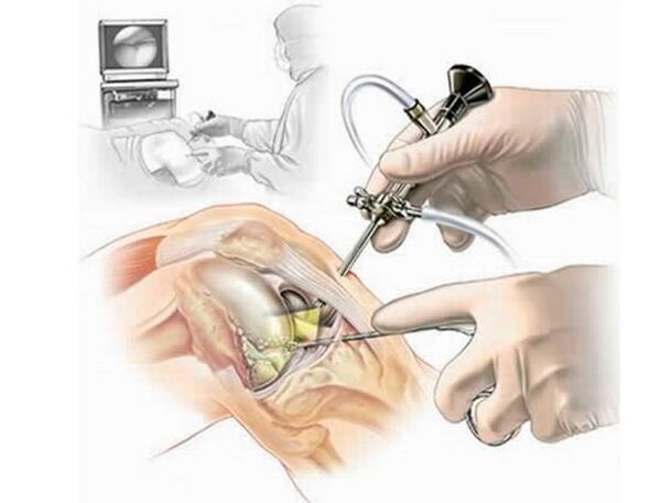 Knee joint arthroscopy