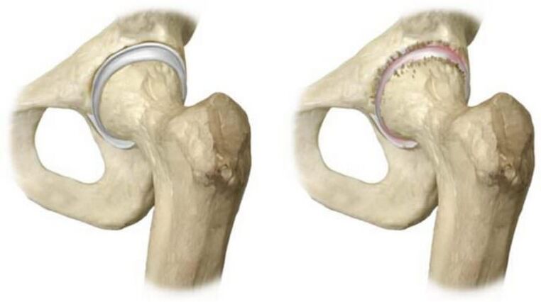 healthy hip joint and head necrosis as a cause of pain