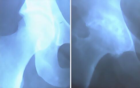 image of osteoarthritis of the knee joint