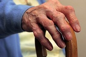 damage to fingers with osteoarthritis