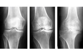 stages of osteoarthritis of the joint on an x-ray