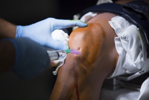 Injections in the knee joint for osteoarthritis. 